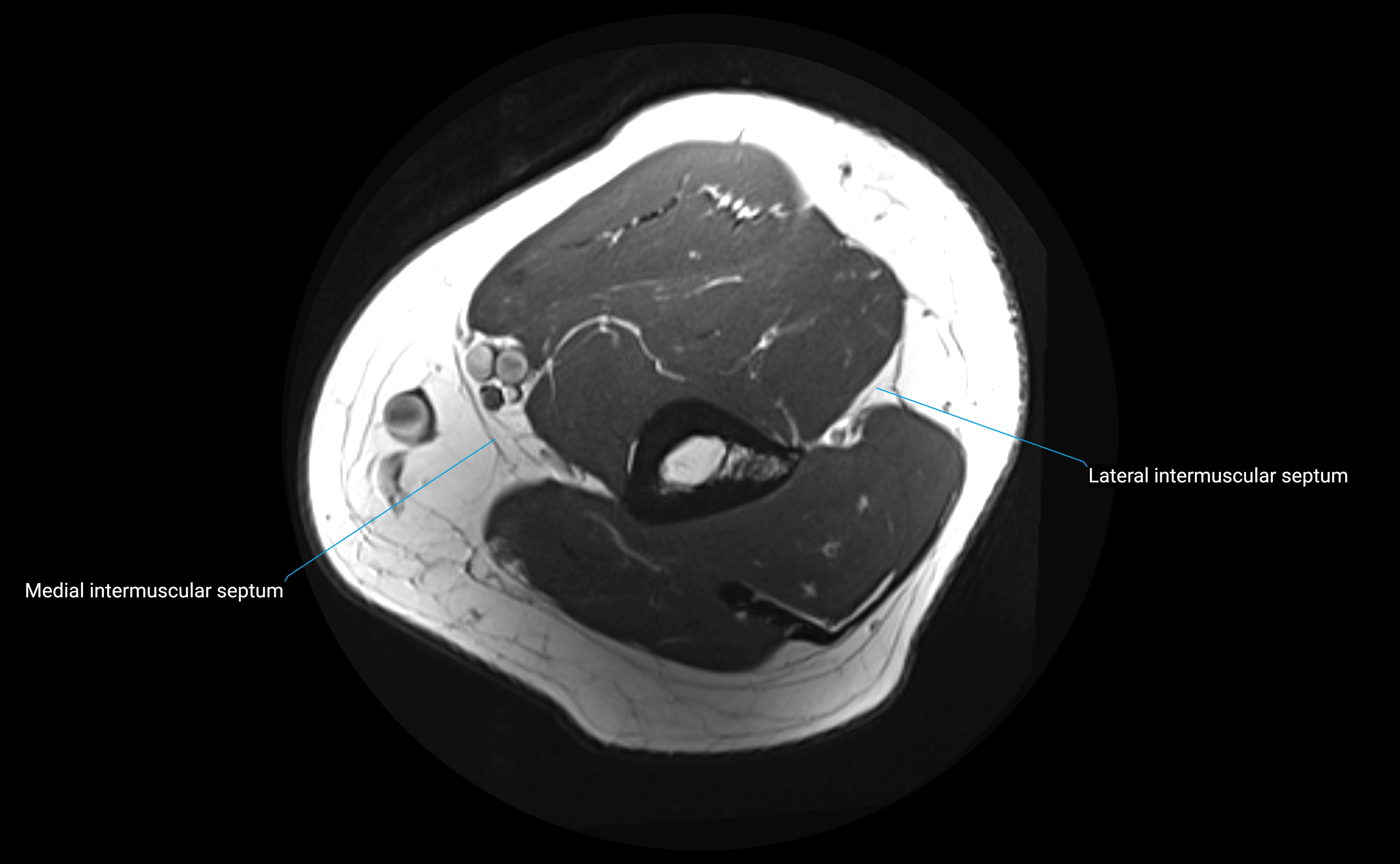 MRI elbow ligaments axial cross sectional anatomy 3T  radiology  image-img-00001-00001.webp
